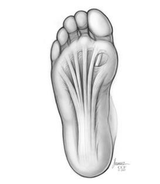 Plantar Fasciitis - What is it and how do we treat it? | Paradigm ...